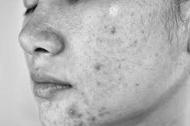 Arturo Ignacio Siso Sosa: Remedios caseros para el acné